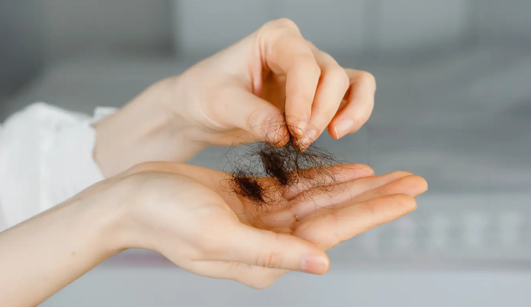 Hair Loss in Summer and Sweating (My Personal Experience)